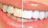 Top Gum Specialist Dentist in Manhattan NYC