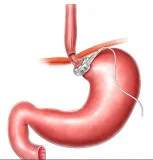 Find a Specialist of Bariatric Surgery in Melbourne