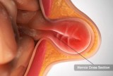 Best Hernia Treatment In India