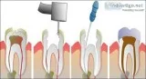 Root Canal Treatment in Delhi By Expert Dentist