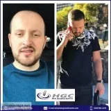 Exclusive Hair Transplant in London at an affordable price