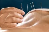 Etobicoke Acupuncture