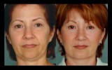 Best facelift surgeon Miami - Dr. Ramirez Plastic Surgeon