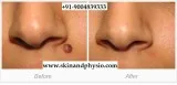 BEST TREATMENT FOR MOLE REMOVAL