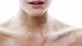Find suitable Vitiligo Treatment in Delhi