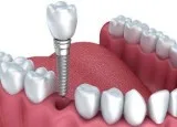 Dental Implants Plano TX