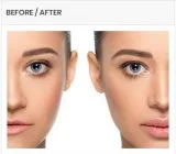 best botox skin treatment in hyderabad