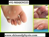 BEST TREATMENT FOR CORN
