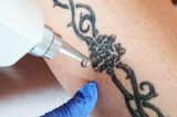 Laser Tattoo Removal