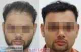 Best Hair Transplant In Mumbai At Medispa India