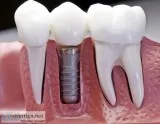 Dental Implants Mississauga  Best Tooth Replacement