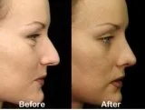Top Rhinoplasty Surgeon in Los Angeles  Calwestent.com