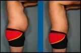 Body lift Miami - Dr. Ramirez Plastic Surgeon