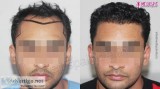 Get the best FUT Hair Transplant in India at Medispa by Dr. Sune