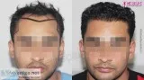 Get the best FUT Hair Transplant in India at Medispa by Dr. Sune