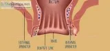 Best fistula Ayurvedic Doctor in Delhi NCR  Ayurvedic Fistula Tr