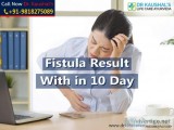 Fistula Ayurvedic Treatment in Delhi (Without Surgery)