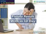 Fistula Ayurvedic Treatment in Delhi (Without Surgery)