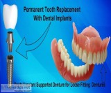 Treat your dental problem at best dental implants in kolkata
