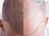 Hair Transplant Clinics UK  Revive Hair and Skin Clinic