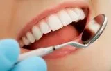 Porcelain Veneers in Bellevue - Dental Veneers Bellevue WA