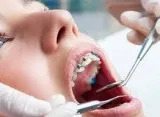 Best Dental Implant Surgeon Bellevue - Dental Implants Bellevue 