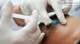 Hair Transplant in Delhi