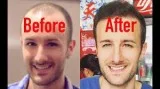 HAIR RESTORATION IN MUMBAI