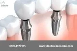 Dental Implants in Noida - Trust Our Experienced Dentists