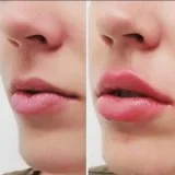 Best Lip Fillers in Austin