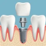 Beautiful Artificial teeth insert to give you the healthy smile.