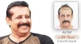 Check out the Celebrity Hair Transplant at Medispa by Dr. Suneet