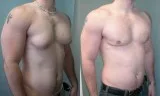 Laser Treatment For Gynecomastia In Delhi