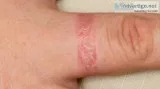 Consult with a dermatologist and get away from dermatitis