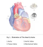 Aortic Valve Replacement