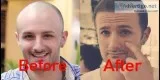 Know about Best Hair Treatment Near Me
