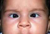 Best Squint Surgery in Delhi