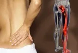What causes sciatica