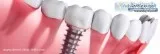 The Best Quality Basal Dental Implants