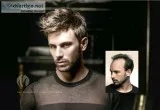 Hair Replacement for Men &ndash Minneapolis St. Paul