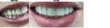 Transform your smile with dental implants New York