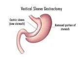 Gastric Sleeve Surgery Mexico