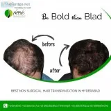 best non surgical hair replacement for men