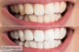 Teeth Whitening in Miami