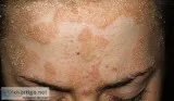 Homeopathic Medicine for Psoriasis