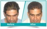 Best Hair Transplant in Mumbai