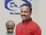 Hair Transplant in Delhi