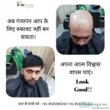 Hair Patch in Gurgaon