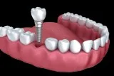 Dental clinic in Bareilly  dentist in bareilly