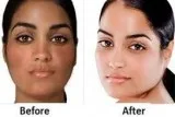 Get the best Skin Whitening Treatment in Delhi by the Dr. Nihari